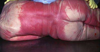 Bright red skin discoloration as a result of exposure to hydrogen cyanide