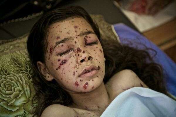 Palestinian child victim of Israeli IDF Dime Bomb